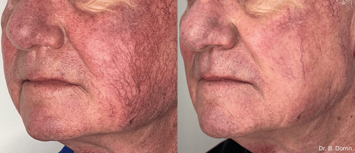 Lumecca IPL before and after, clearer and more even skin tone