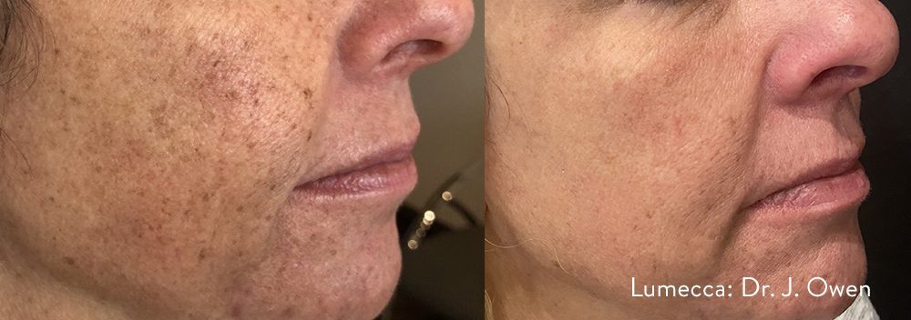 Lumecca IPL before and after, brown spots faded