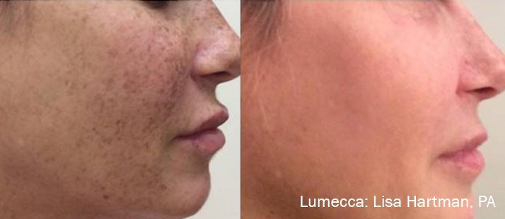 Lumecca IPL before and after result