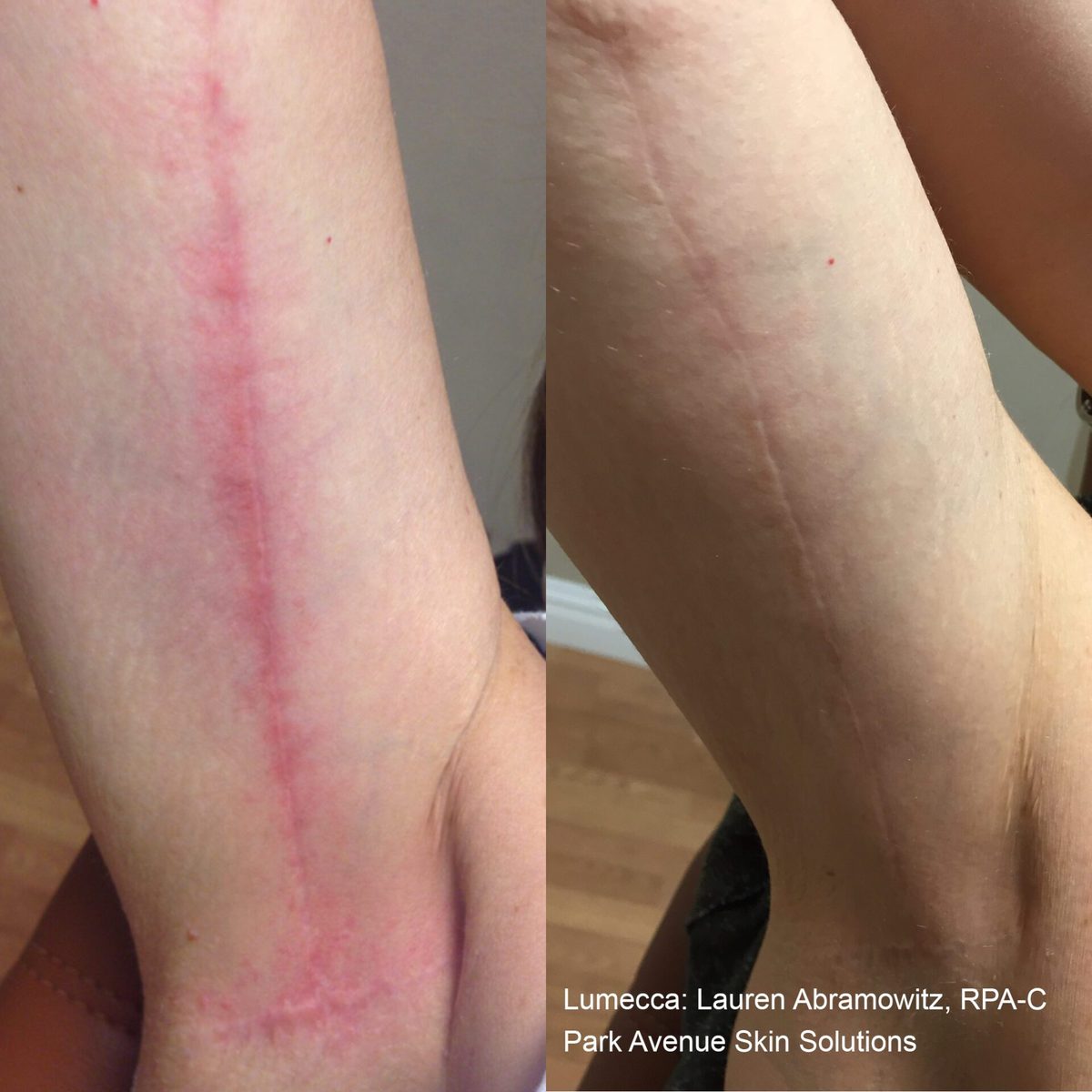 Lumecca IPL before and after result