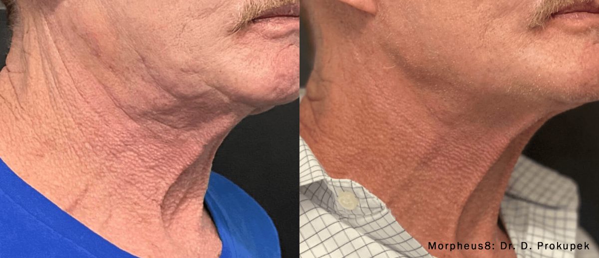 Morpheus8 before and after result