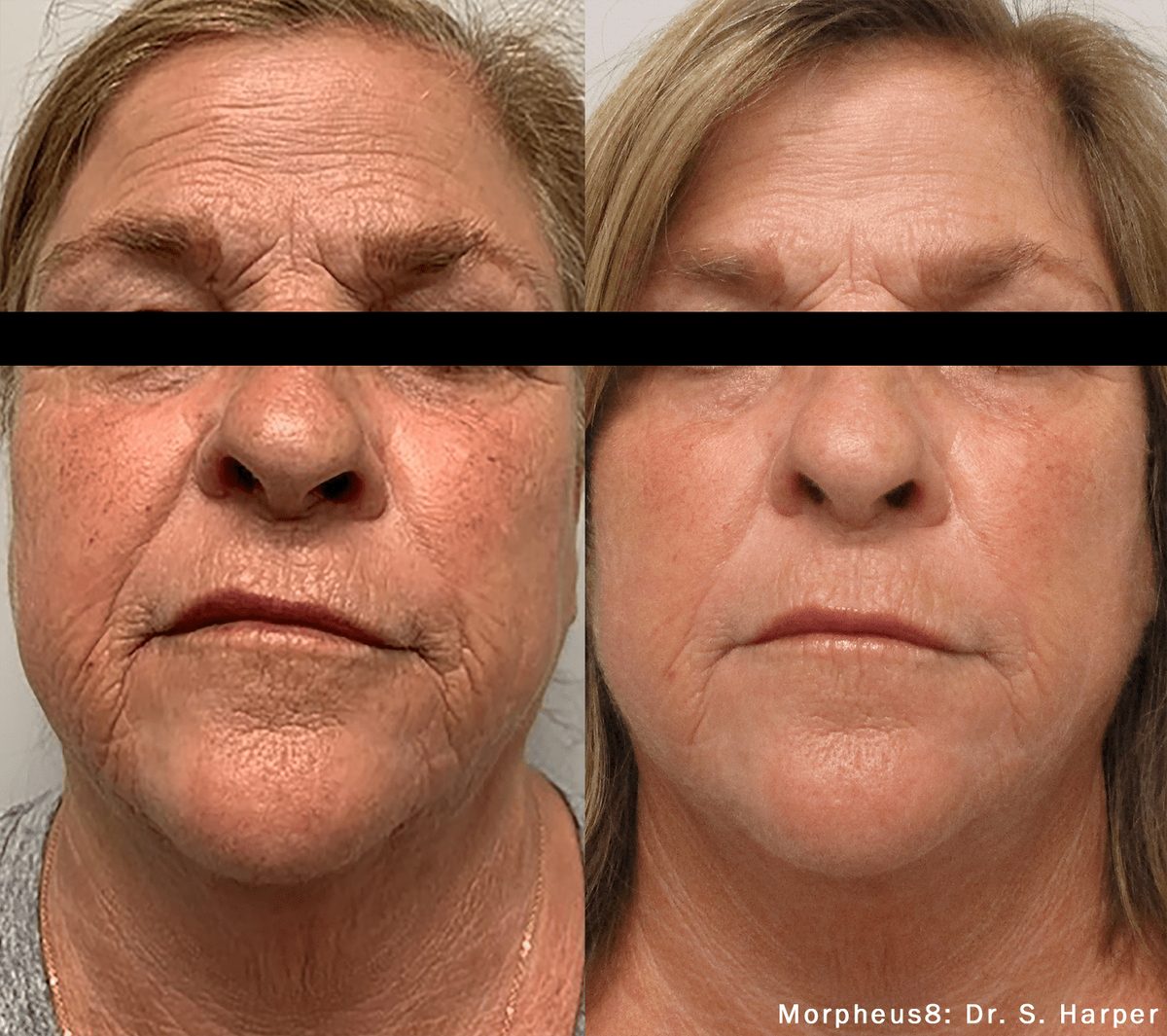 Morpheus8 before and after result