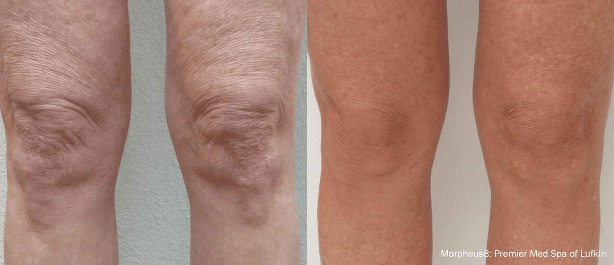 Morpheus8 before and after result